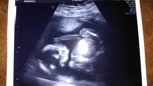 September 2016 - End of pregnancy sickness is in sight....please!