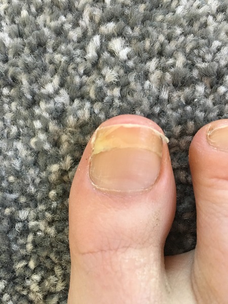 What is the matter with my toe nail?