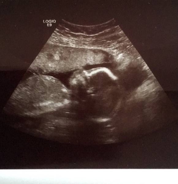 August 2016 number 4 - bumps popping and scans happening, we actually have babies!