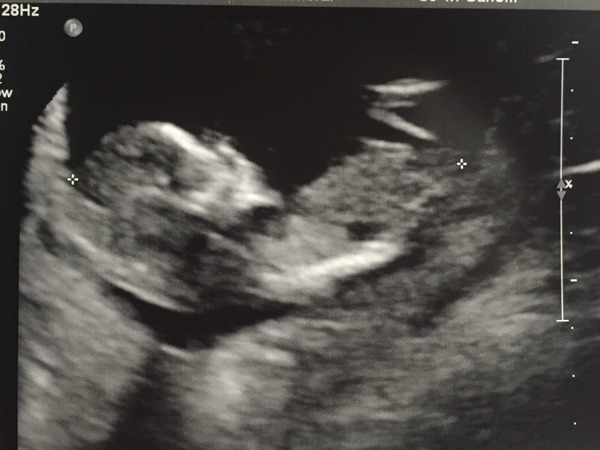 October 2016 (thread number four). Entering the second trimester.