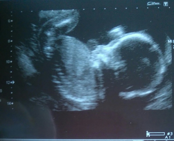 September 2016 - End of pregnancy sickness is in sight....please!