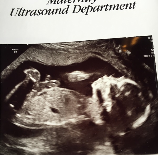 August 2016 number 4 - bumps popping and scans happening, we actually have babies!