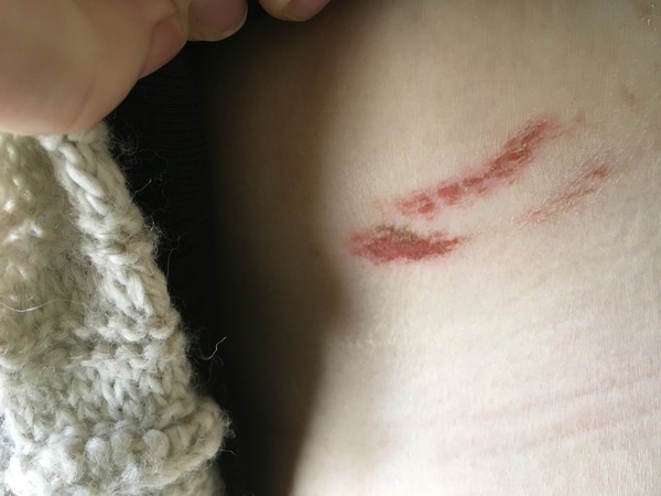 Bizarre running injury (with picture!) - please help - race on Sunday