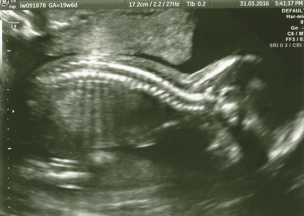 August 2016 number 4 - bumps popping and scans happening, we actually have babies!