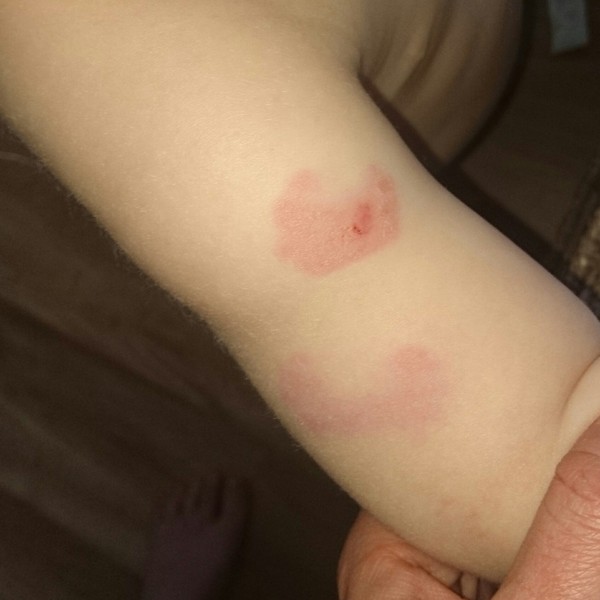 DD bitten at nursery - am I overreacting?