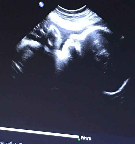 June #8 Kicks, rolls and thwacks! Need help putting socks on! Living off of chocolate! Its the last trimester people!!!!