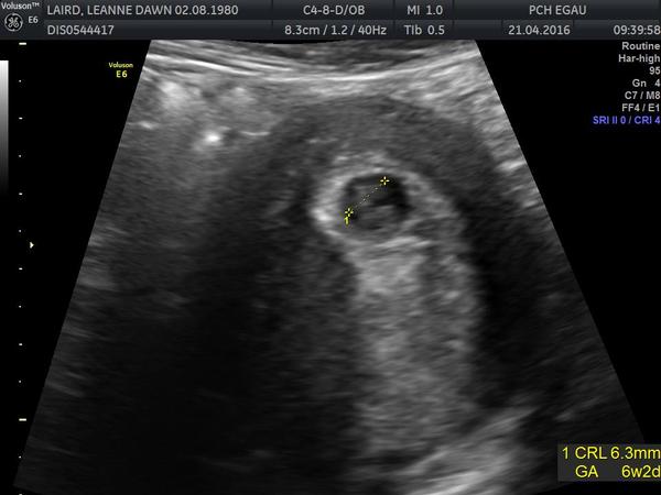 Is anyone ultrasound experienced or knows anything about the Ramzi theory?