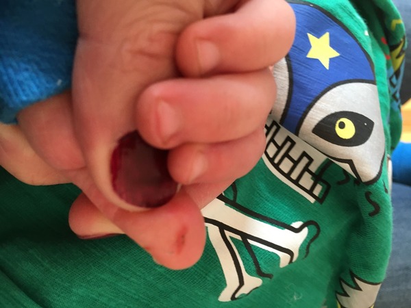 Thumbsucker with painful cut / sore on thumb. WWYD?