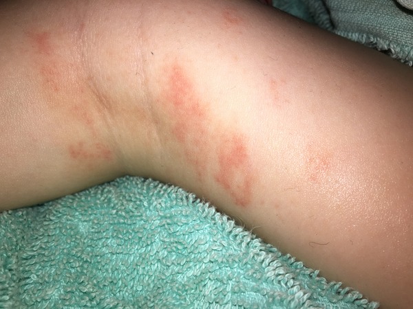 Eczema? Ringworm? Something else?