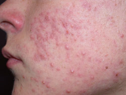 Teen daughter acne