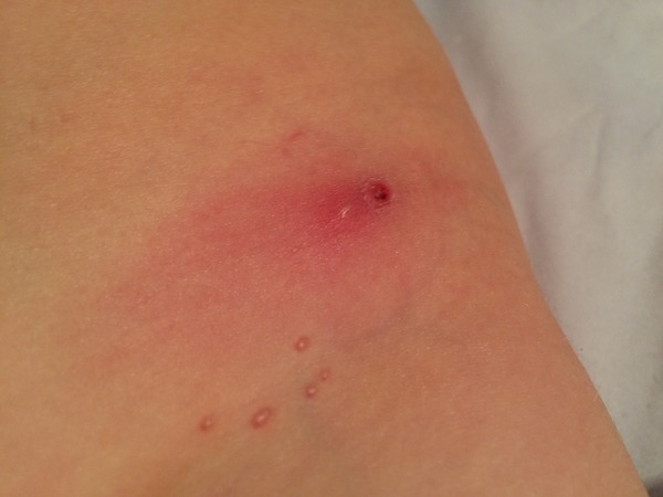 What is this 'spot' cluster on ds's groin? Pic attached.