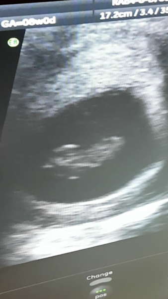 Morning sickness and first scan anticipation - it's the December 2016 babies.