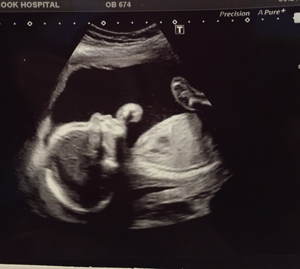 August 2016 number 4 - bumps popping and scans happening, we actually have babies!