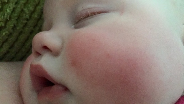 Red cheeks