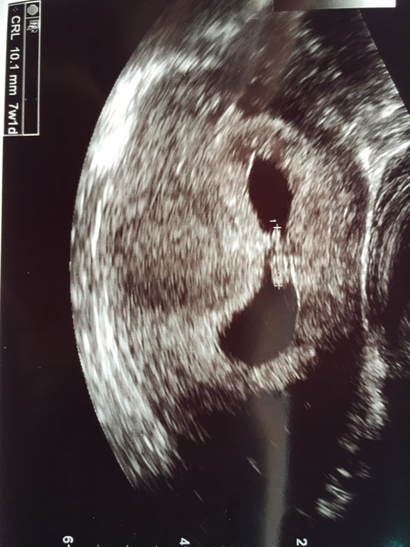 Ttc after stopping the pill thread 3. Join us for: Super long cycles, living in limbo, obscene amounts of poas and trying anything and everything to get that bun in the oven!