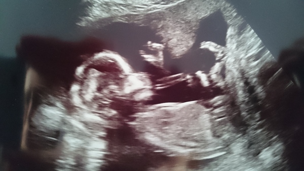 Pregnancy after infertility