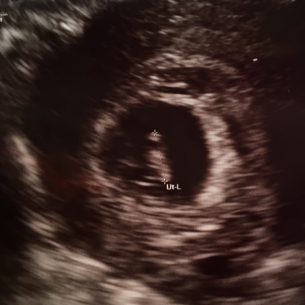 Pregnancy after infertility