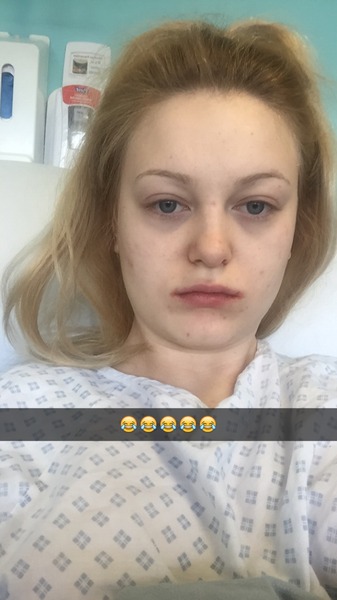 Tonsillectomy in adults - please come and share your experiences