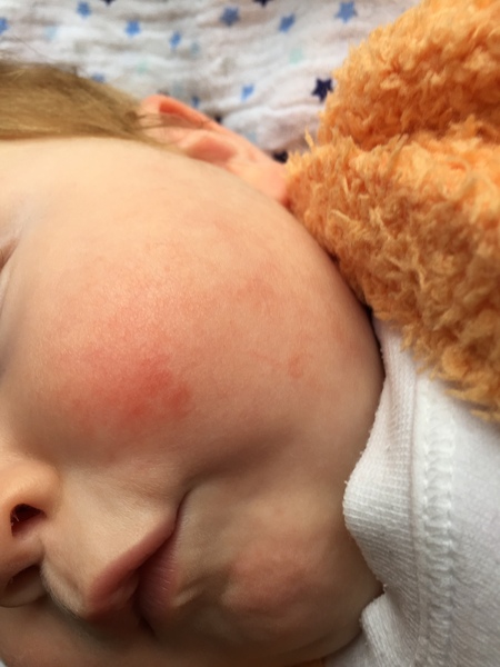 Red cheeks