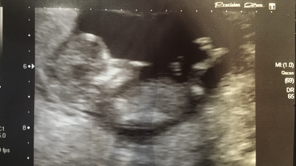 October 2016 (thread number four). Entering the second trimester.