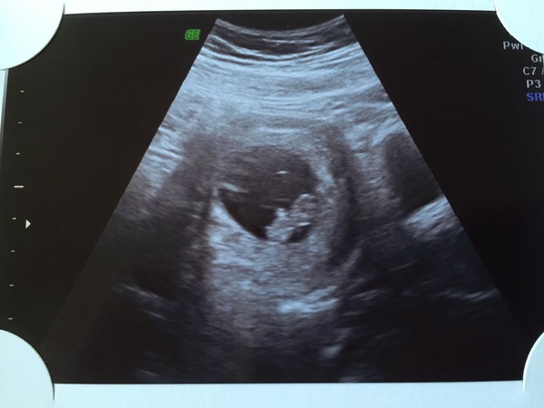 Morning sickness and first scan anticipation - it's the December 2016 babies.