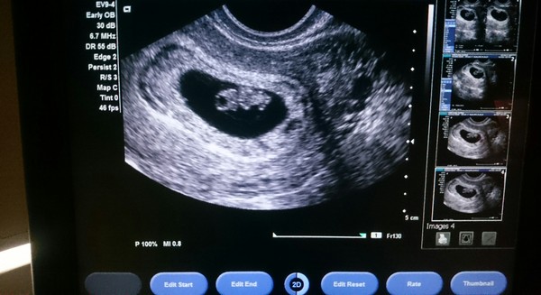 Morning sickness and first scan anticipation - it's the December 2016 babies.