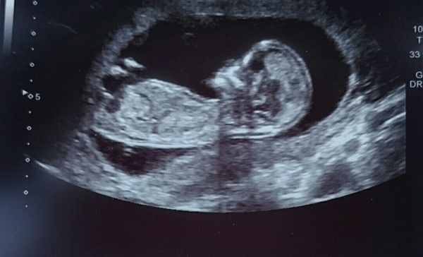 Pregnancy after infertility