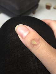 *Klaxon* I have a infected thumb