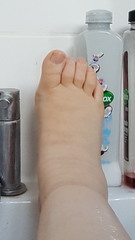Swollen feet and ankles