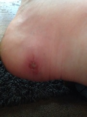is this okay? really yucky photo of blister warning!!!