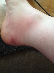 is this okay? really yucky photo of blister warning!!!