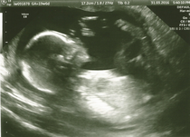 August 2016 number 4 - bumps popping and scans happening, we actually have babies!