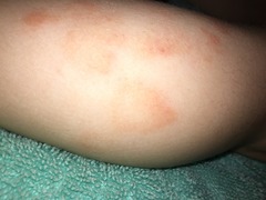 Eczema? Ringworm? Something else?