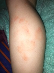 Eczema? Ringworm? Something else?