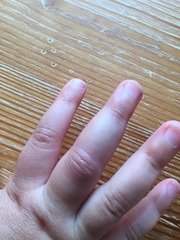 Do I take DD to A&E? (Pic)