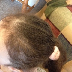 3yr old DD thinning hair - see photo
