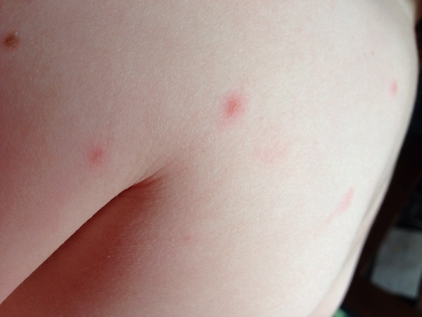 is this chicken pox?