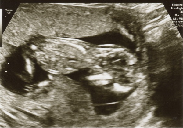 More scan waiting and symptom analysis from the December 2016 babies!