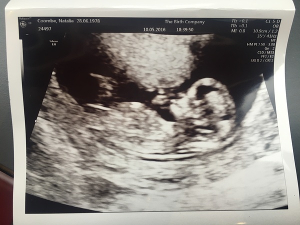 TTC through Donor IUI or Donor IVF or just undecided - all welcome!