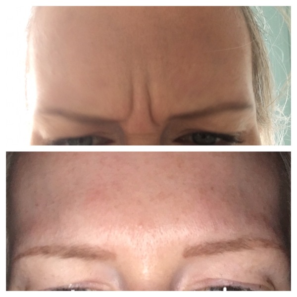 Botox, fillers or wrinkle cream (pic included)