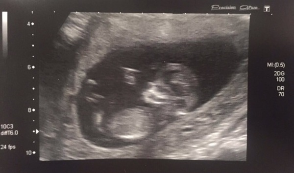 More scan waiting and symptom analysis from the December 2016 babies!