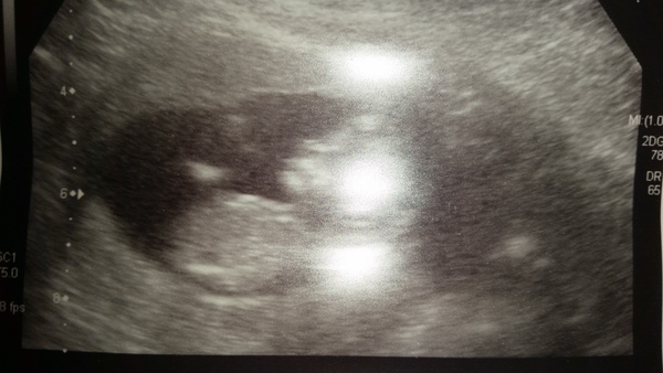 More scan waiting and symptom analysis from the December 2016 babies!