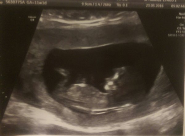 More scan waiting and symptom analysis from the December 2016 babies!