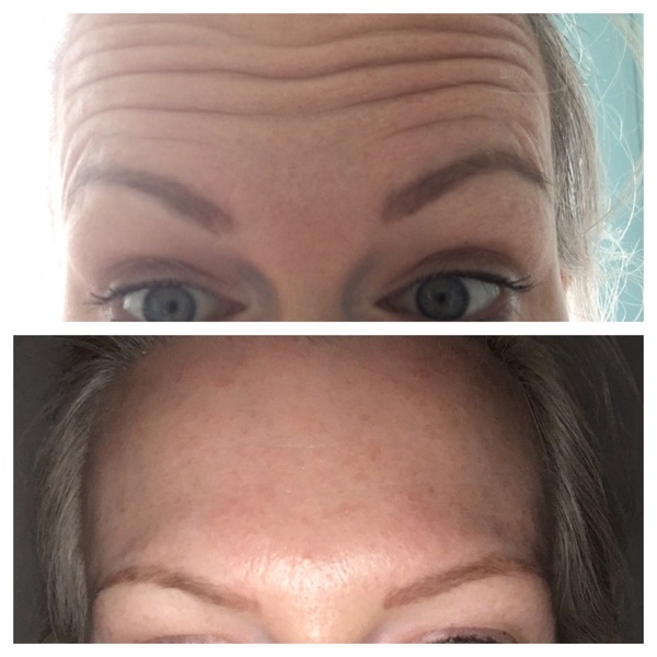 Botox, fillers or wrinkle cream (pic included)