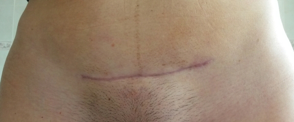 Does my EMCS scar look normal 4 months on?
