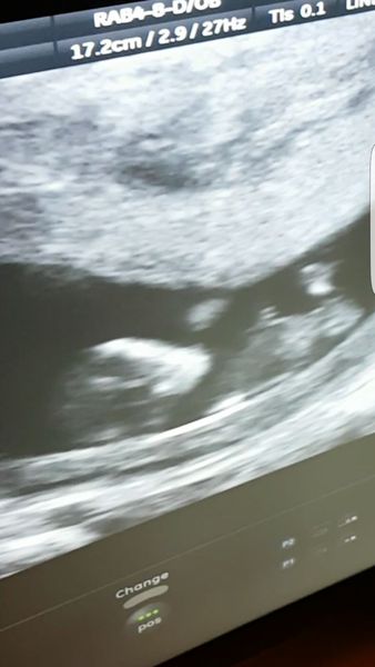 More scan waiting and symptom analysis from the December 2016 babies!