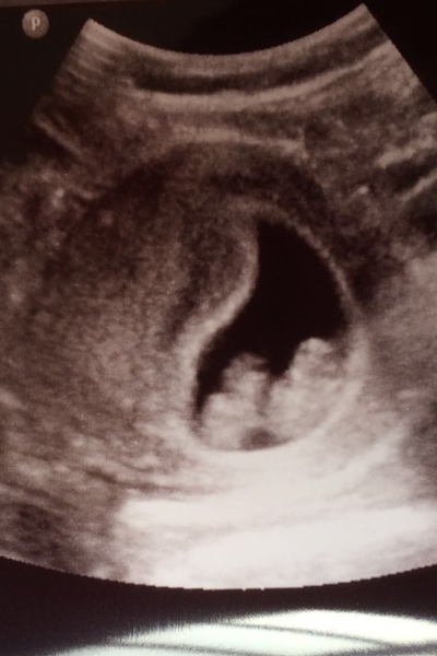 Morning sickness and first scan anticipation - it's the December 2016 babies.