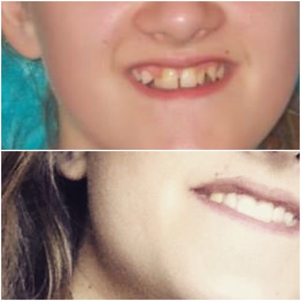 Braces/Orthodontic treatment - what do I need to think about/ask?