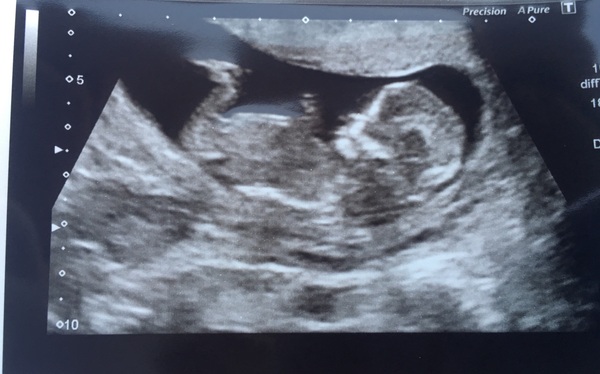 October 2016 (thread number four). Entering the second trimester.