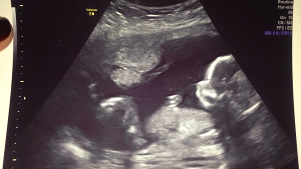 October 2016 (thread number four). Entering the second trimester.